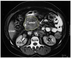 CT Scan / CTA in Clearwater, Dunedin and Palm Harbor epidural catheter diagram 