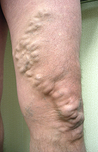 Varicose Veins