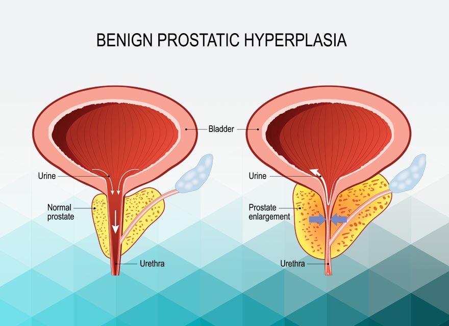 Benign Prostatic Hyperplasia